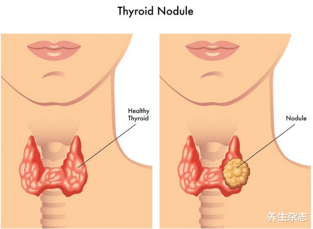 甲状腺结节|85岁院士呼吁:体内有结节的人,尽量少吃4种“发物”,管住嘴或能散结