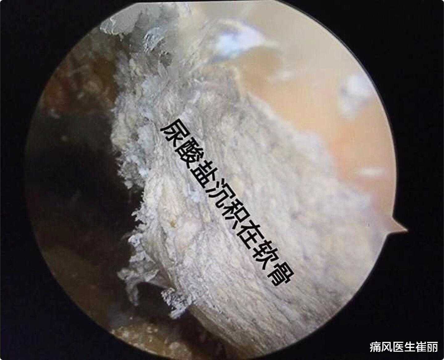 饮食|为什么尿酸快速下降会诱发痛风