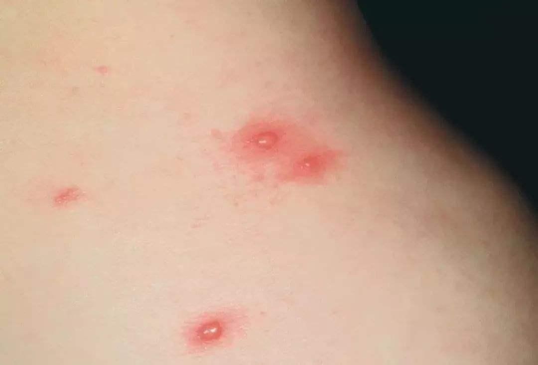 皮肤瘙痒|瘙痒不一定是皮肤干燥,或许是身体内脏出了问题,几种病因要警惕