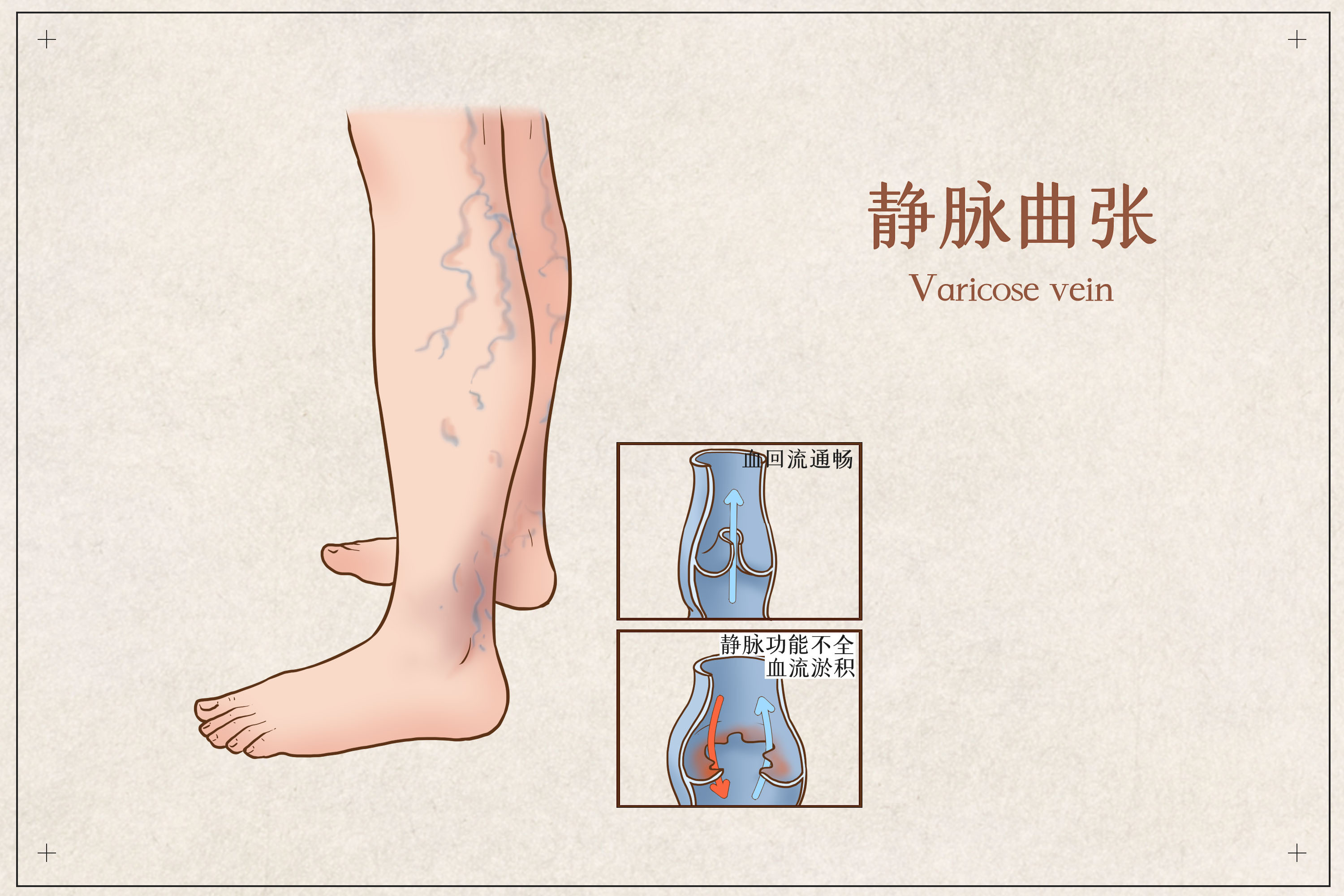 静脉曲张|下肢静脉曲张，要早治！川蜀专家：不要等腿烂了才治，此时久难以根治了！