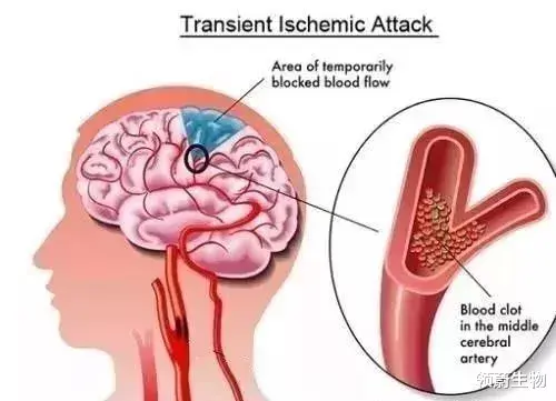肾虚|干细胞治疗，治愈脑梗的希望之光