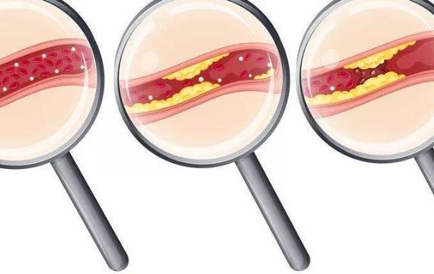 睡眠|血管堵不堵,睡觉就能知道,4个症状若出现,不妨做个检查吧!