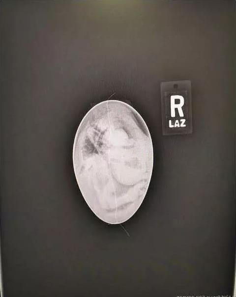 肺癌|盘点30张奇奇怪怪的X光片，看完整个人都不好了！