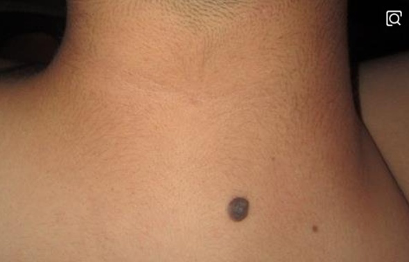 肝脏|身上出现这种肉痣,可能透露了肝的“小秘密”,早发现早预防!