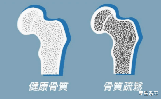 骨质疏松|腰背出现3“异状”，无论男女，多半骨头早已“窟窟窿窿”，趁早检查骨密度