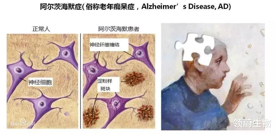 找回丢失的记忆,干细胞有望逆转阿尔茨海默病