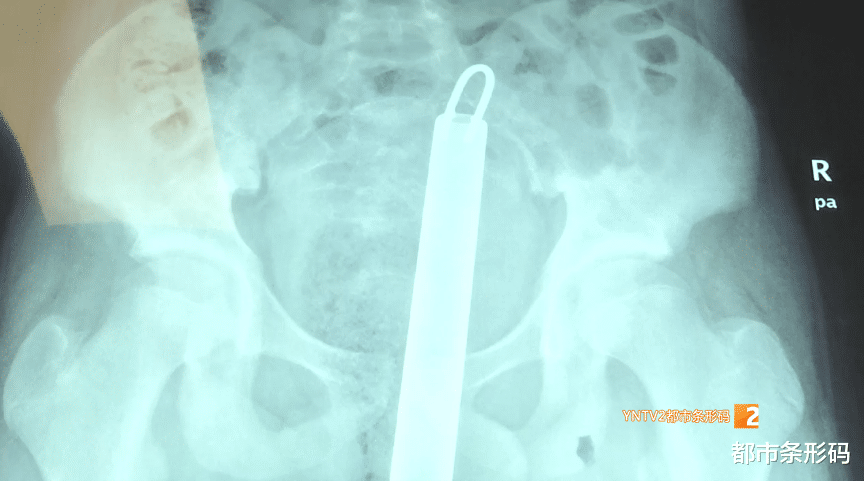 南瓜|太危险!不慎跌落,拖把杆刺入12岁男孩盆腔!医院紧急救治