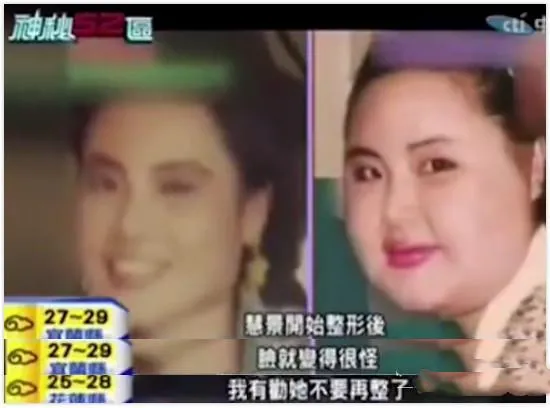 韩慧景|女星韩慧景：为了更漂亮，给脸注射食用油，把脸整成“猪头”