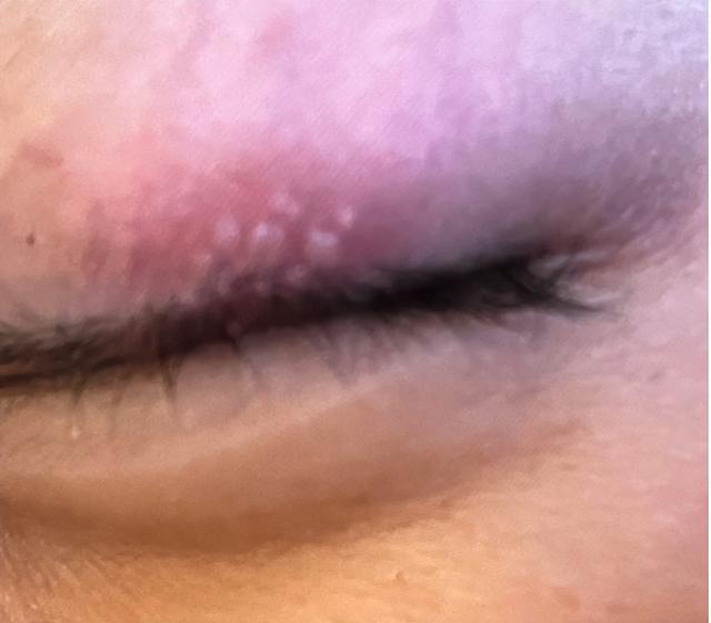 疱疹|新冠高烧后眼皮起水泡,切莫用手揉眼睛!