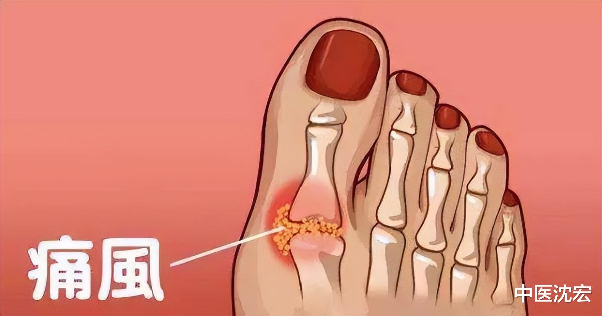 痛风|尿酸高 痛风,源于阴虚!送你一方,滋阴养骨 降尿酸