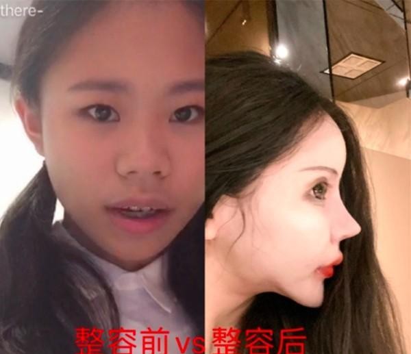 整形|整形成瘾？18岁女孩五年内整形百次，网友：像个芭比娃娃