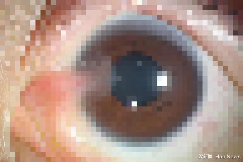 老年病|眼表炎症反复发作未根治 15岁男孩眼部竟患上老年病