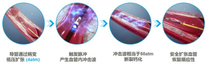 眩晕|血管内冲击波：冠状动脉钙化处理的技术革新