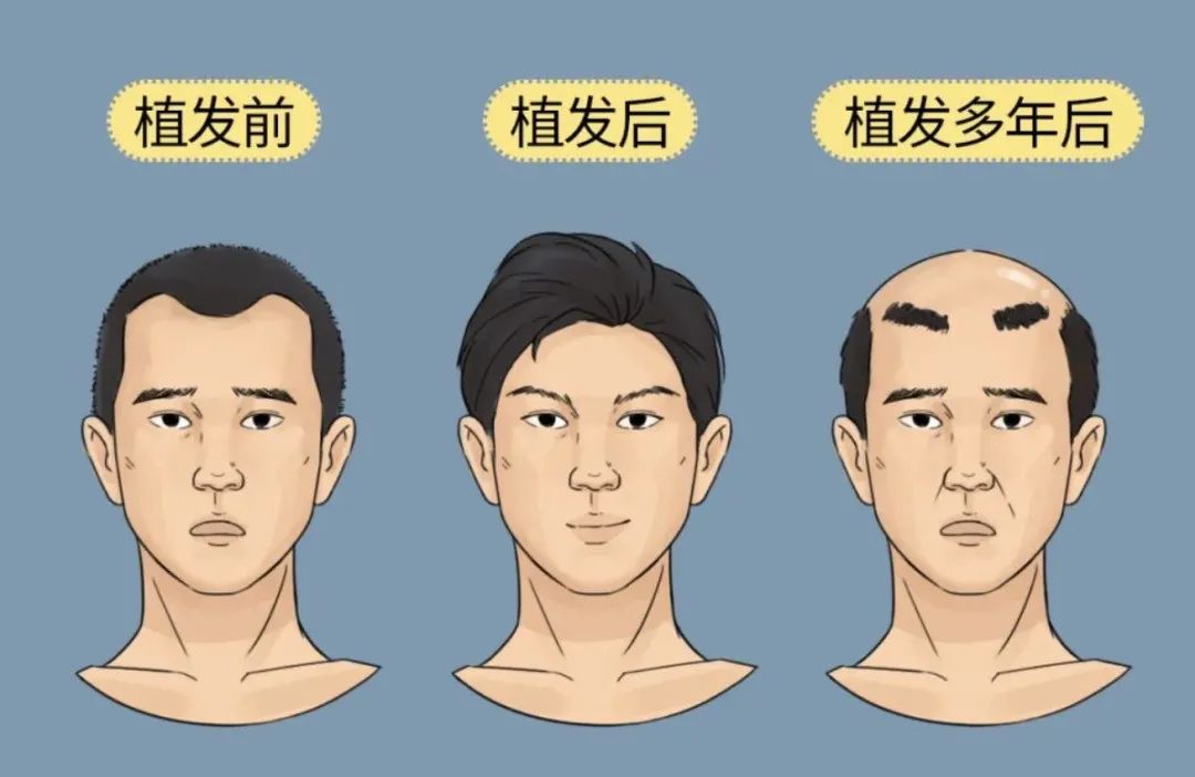 针灸|男人为啥一边秃头,一边长胡子?
