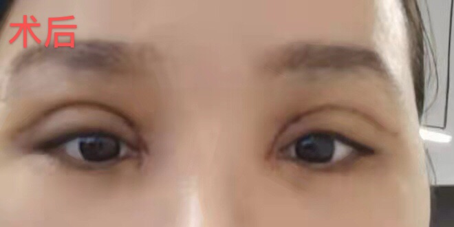鸡胸肉 女子称双眼皮手术后眼睛睁不开 医美机构:是你眼睛问题