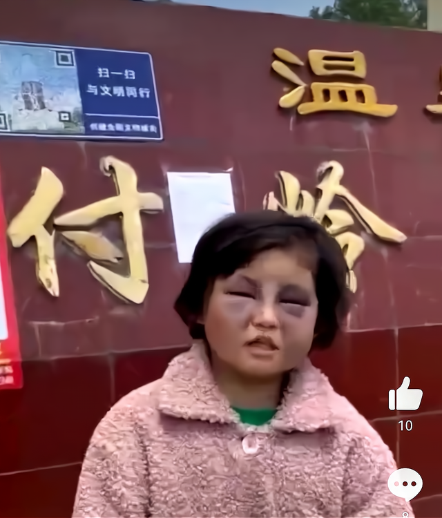 河南一女孩被同学打成熊猫眼 校长、老师对校园暴力一无所知