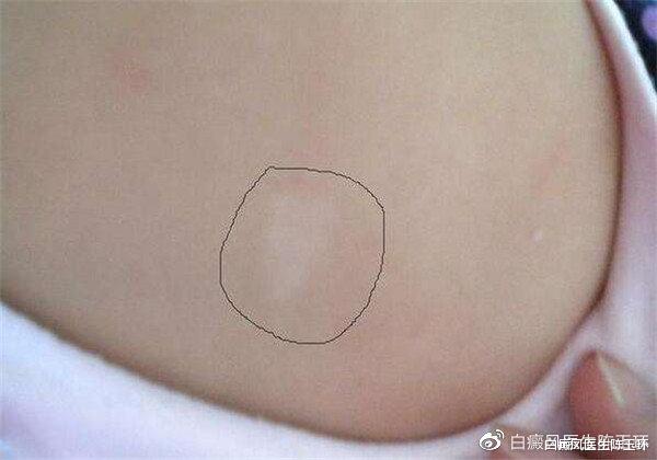 骨质疏松|冬季白癜风患者适宜吃什么?