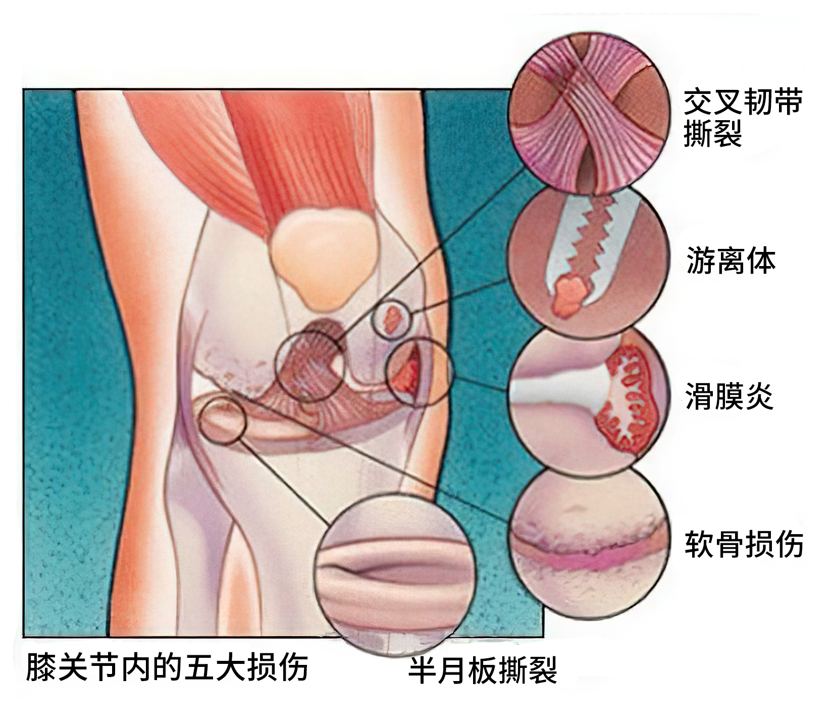 滑膜炎|得了滑膜炎应该怎么办？