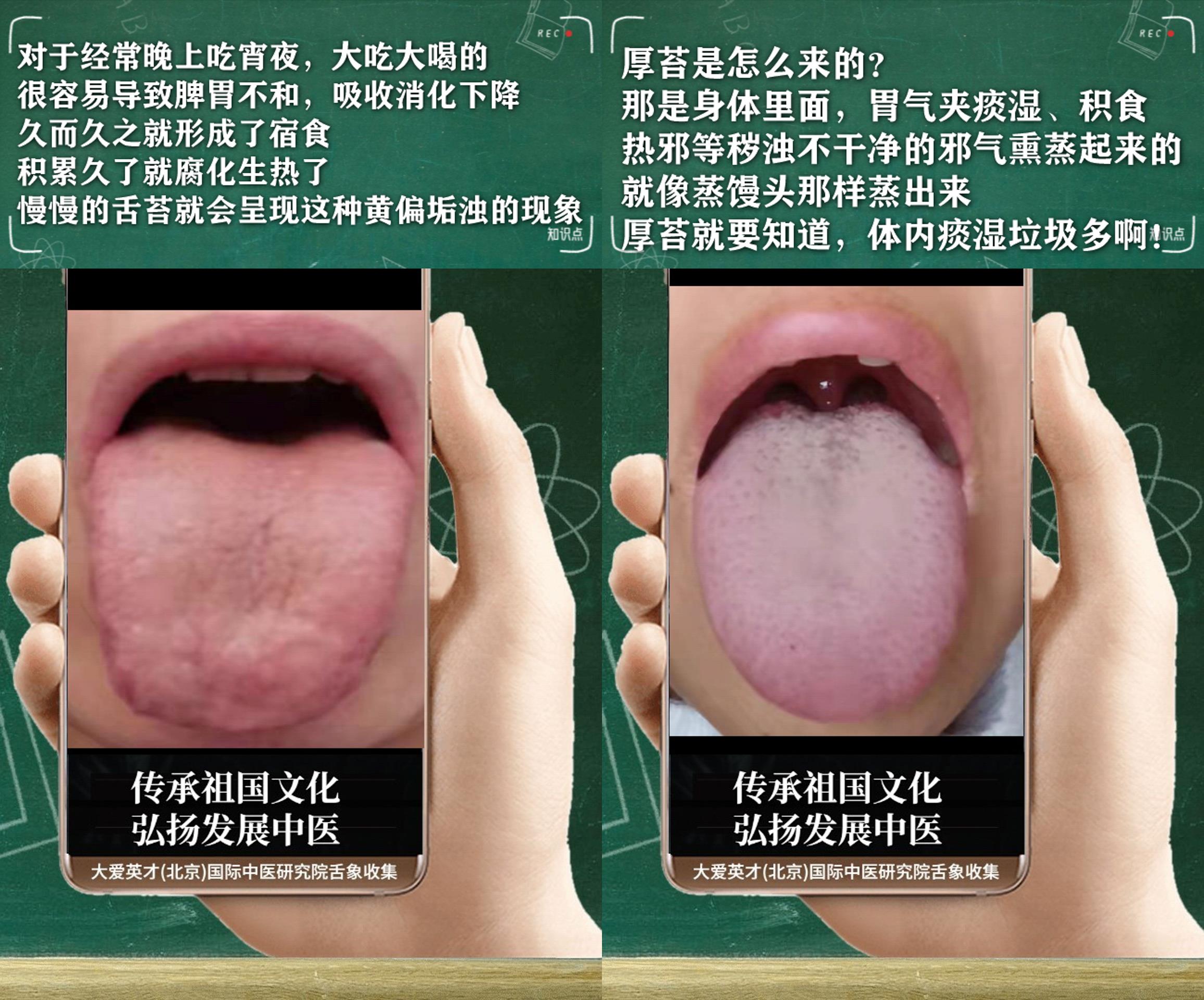 心律失常|反反复复胃胀气,心悸气短,便秘,脾胃不和的舌象案例讲解