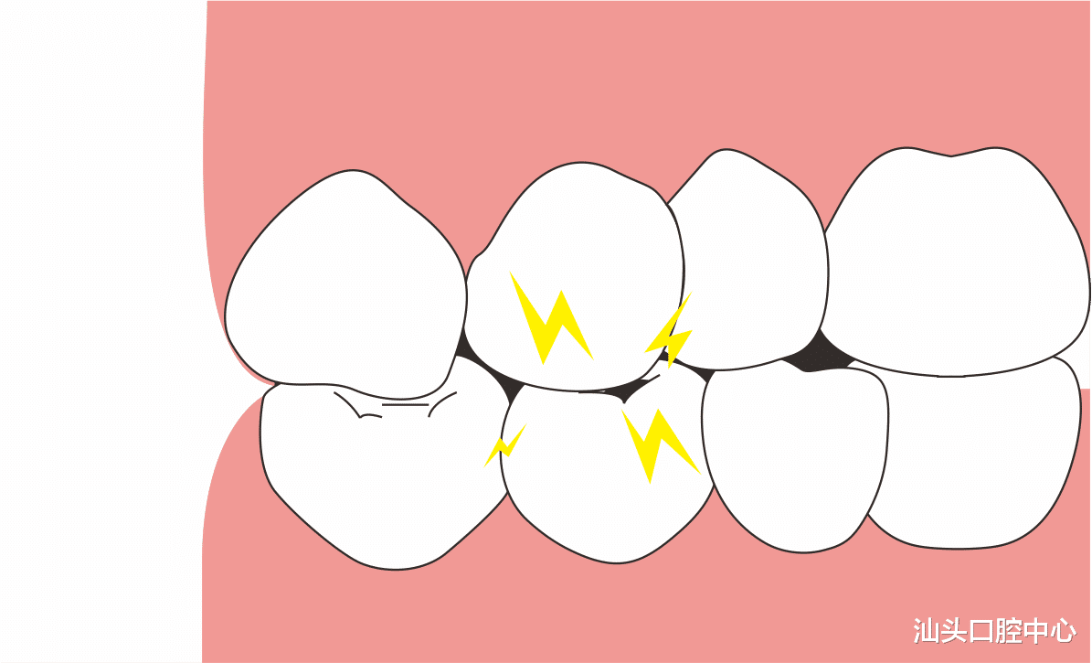 睡眠|?晚上睡觉磨牙居然有这么多危害!快转给你身边有这个习惯的人
