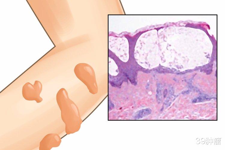 肺癌|54岁男子双脚水肿，诊断肾病，直到出现咳嗽才发现是肺癌