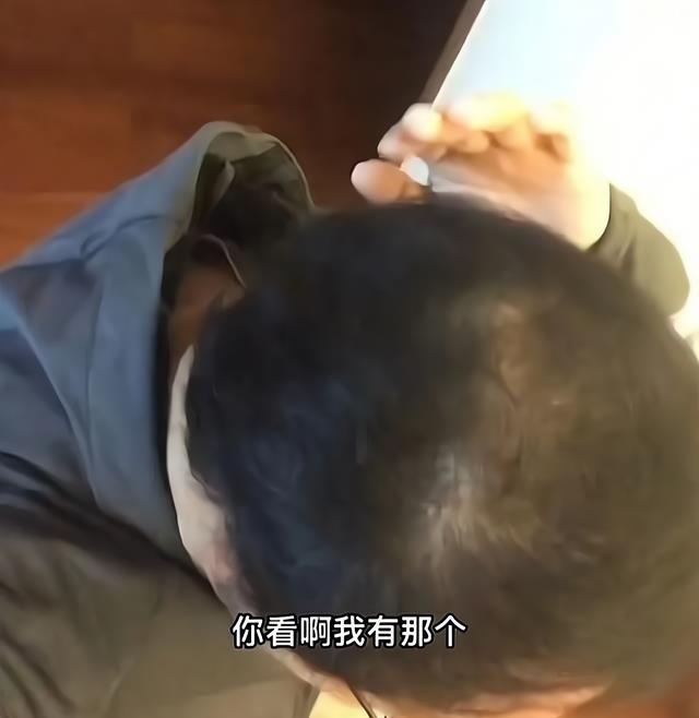 植发 不用洗发水洗头可以长头发，洗发水公司和植发公司都慌了！