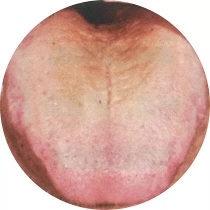 失眠|中医中的舌诊,了解吗