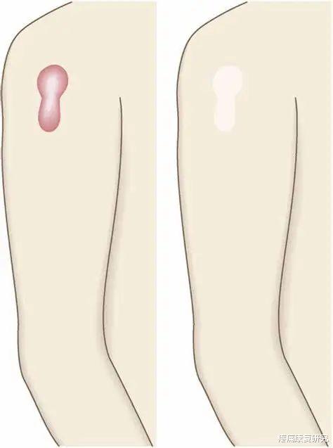 皮炎|皮质类固醇贴剂治疗瘢痕疙瘩和增生性瘢痕