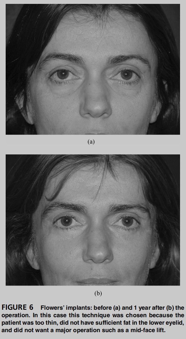 熊师:印第安纹的解剖学特点与治疗进展丨专业视点