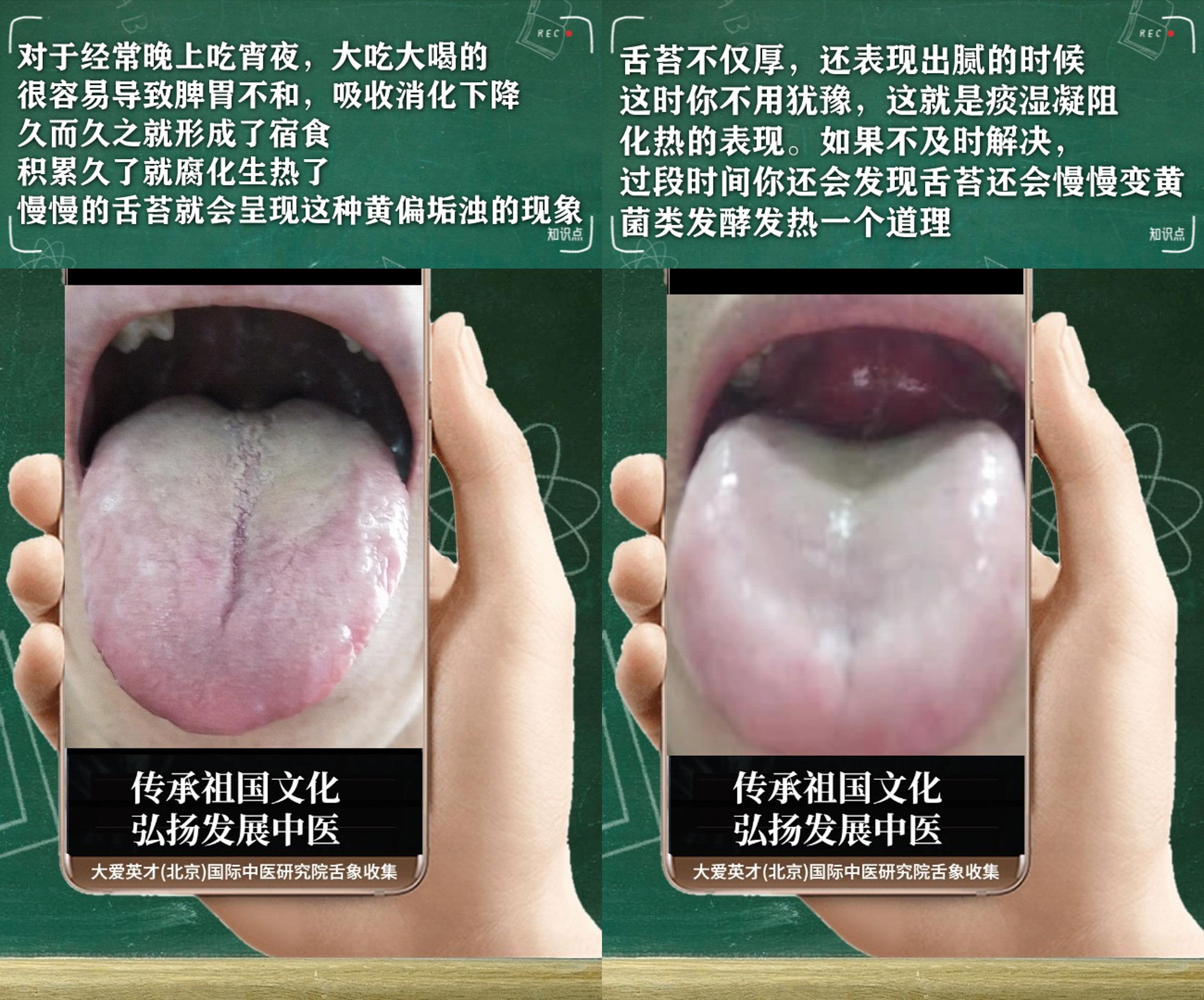 脾胃|中医实例:口干口苦,关节酸痛、痰多色白,脾胃失常