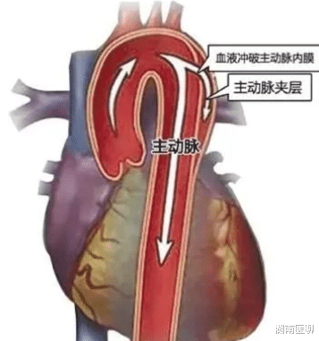 主动脉夹层|一招除“虎患”！石门县人民医院成功救治两例主动脉夹层患者
