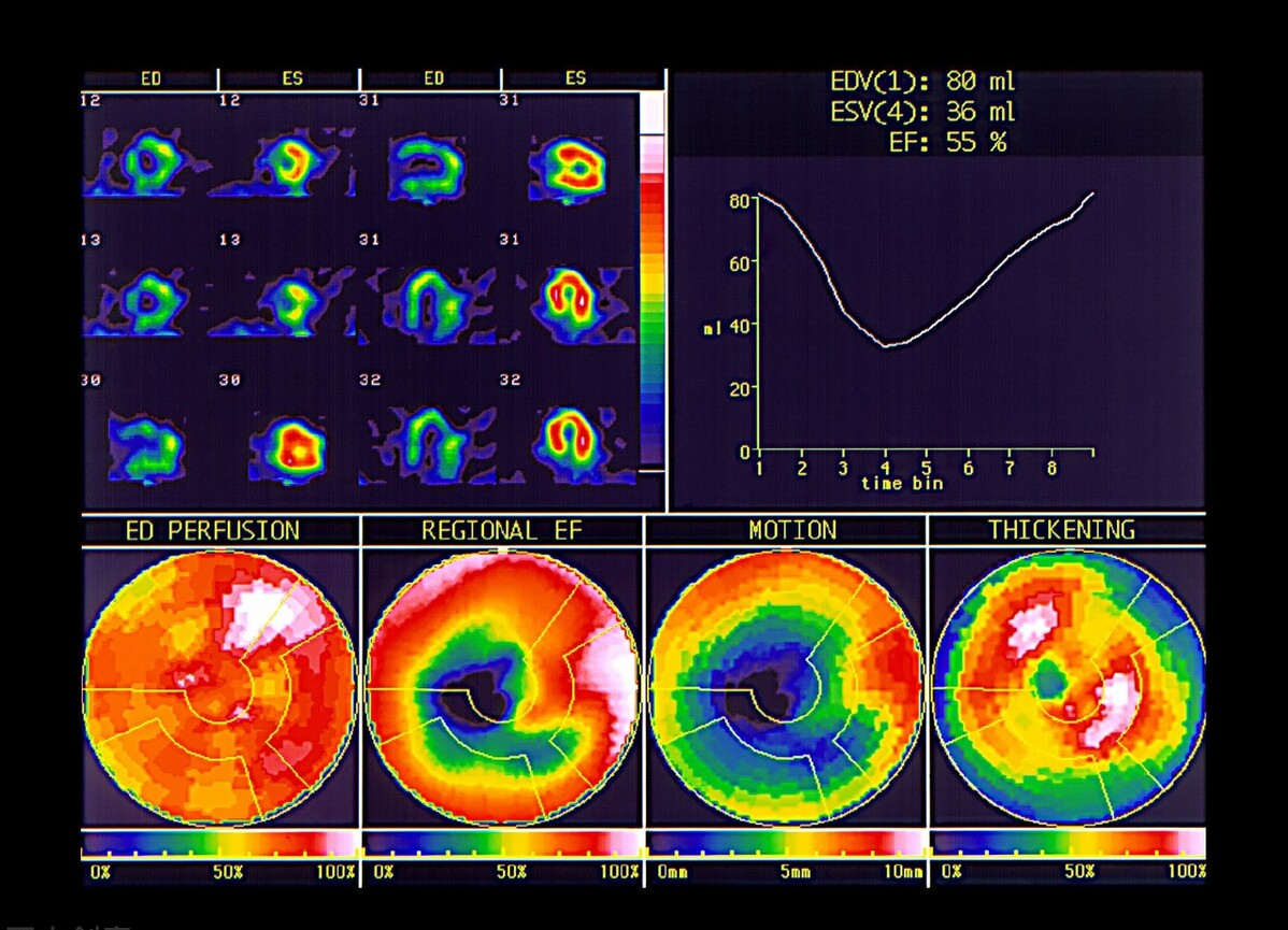 心力衰竭|2个中成药，调节心肾阴阳平衡，益气强心、活血利水，恢复心功能