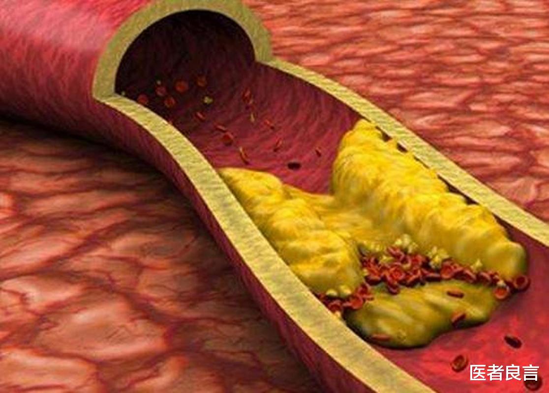 白扁豆|女子吃降压药6年,发生了肾衰竭!提醒:她犯了3大错误,值得反思