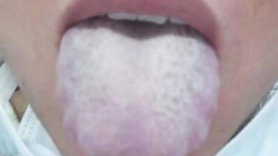 感冒|夏季感冒怎么办？输液治疗不是最佳选择，中医教你正确选用中成药