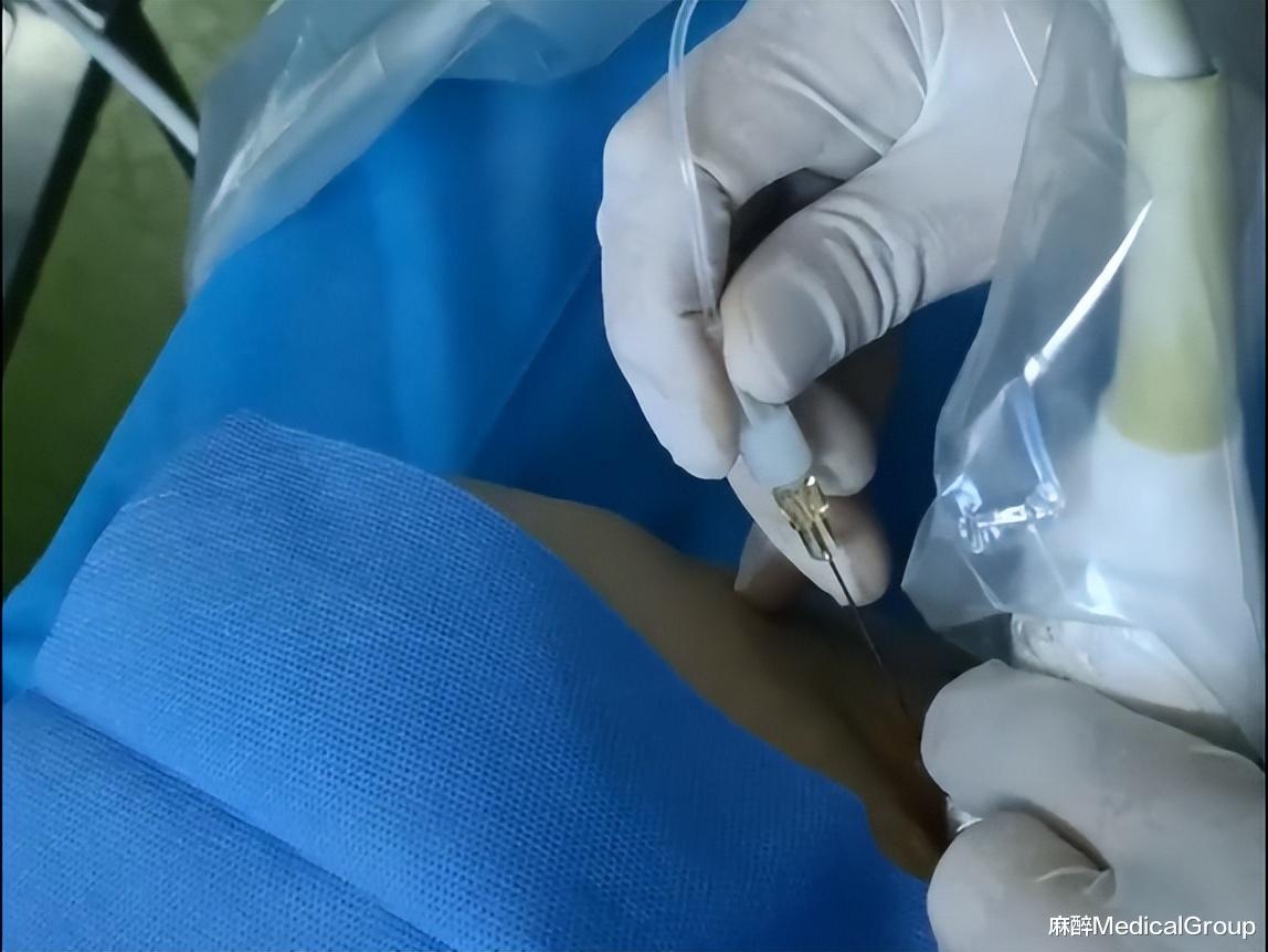 医生|超声——麻醉科临床中的好帮手