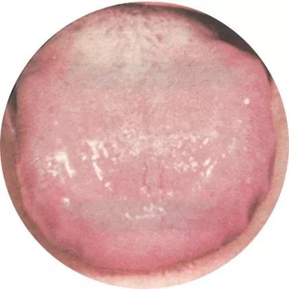 失眠|中医中的舌诊,了解吗