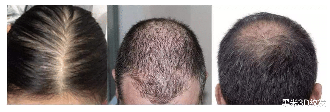 记忆力|怎么判断脱发是不是雄性激素脱发？一般会有这几种表现！