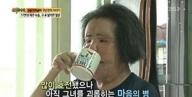 整形|韩国妹子先后做17次手术,取出260克异物,把脸整容成“电风扇”