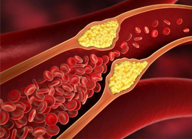 血管堵塞大多是“吃”出来的？6种食物或是“帮凶”，建议少碰