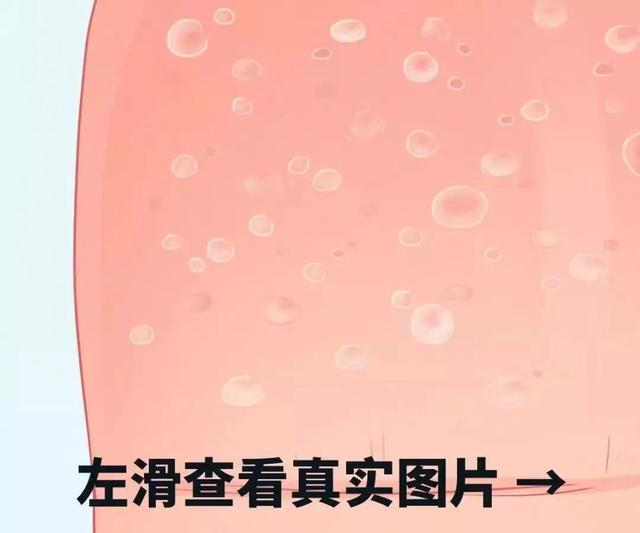 胃炎|警惕！身上的这种小红点是病毒感染，小心越长越多