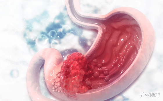 高血压|酱油变“夺命油”?医生:厨房中的“1酱油”,或是胃癌诱发剂,趁早扔