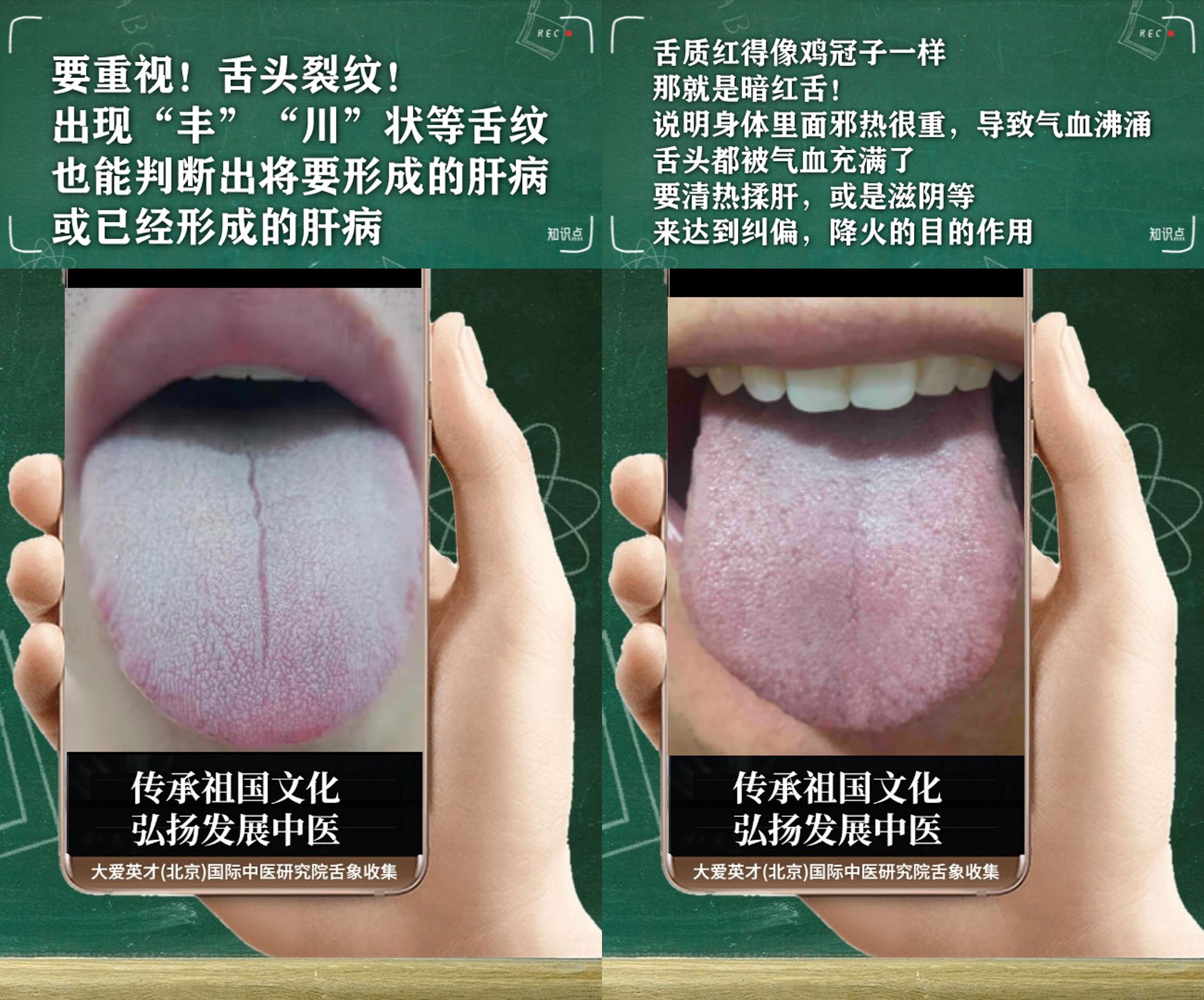 脾胃|经常咳嗽吐痰,积食,容易困倦,记忆力下降的舌象讲解