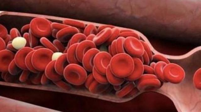 脑梗|身体的这2个地方发“硬”，或是脑梗在悄悄逼近，早发现早好！