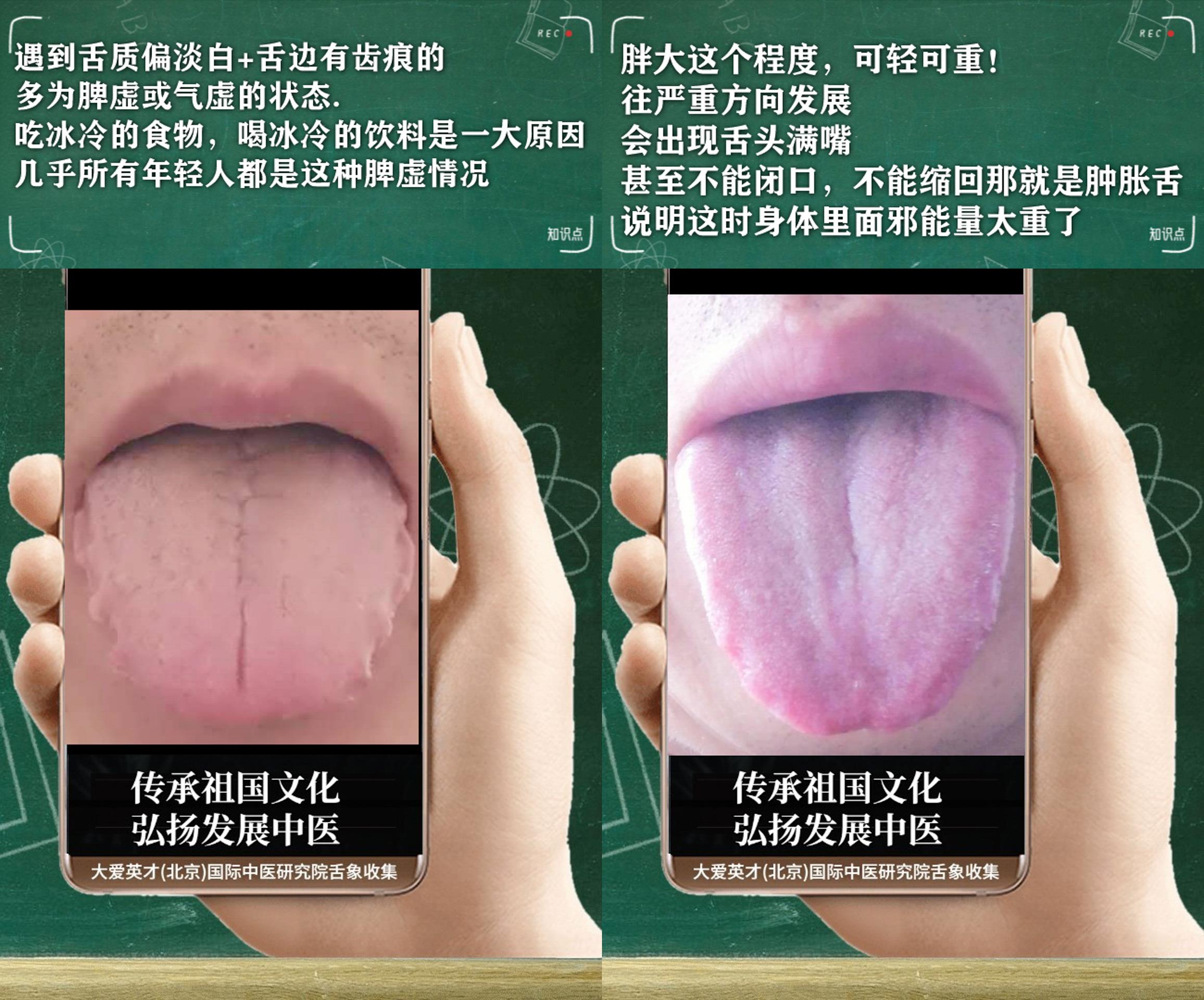 |中医实例:心烦易怒、易生气、容易困倦,肝郁克脾