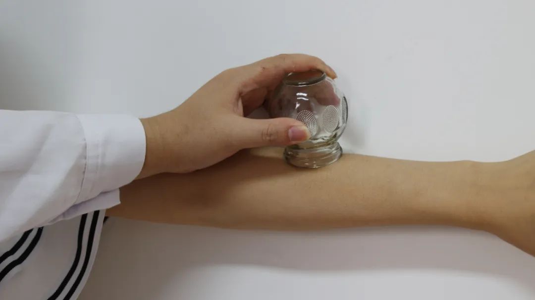 绿豆|拔罐后留下的印迹,与毒素无关,反而与人体皮肤厚薄程度有关?