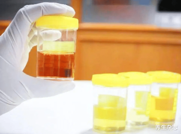 尿酸|肾脏一旦“受损”严重，身体有3个“表现”，预防肾衰竭，要早重视