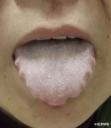 脾胃|裙边舌,白腻苔,多见是湿滞脾胃,教你一方,化掉湿气,建议收藏