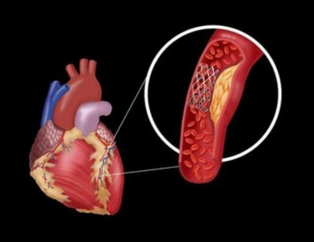 中成药|做完支架手术,该注意什么?这4件事很关键,希望你每天坚持!