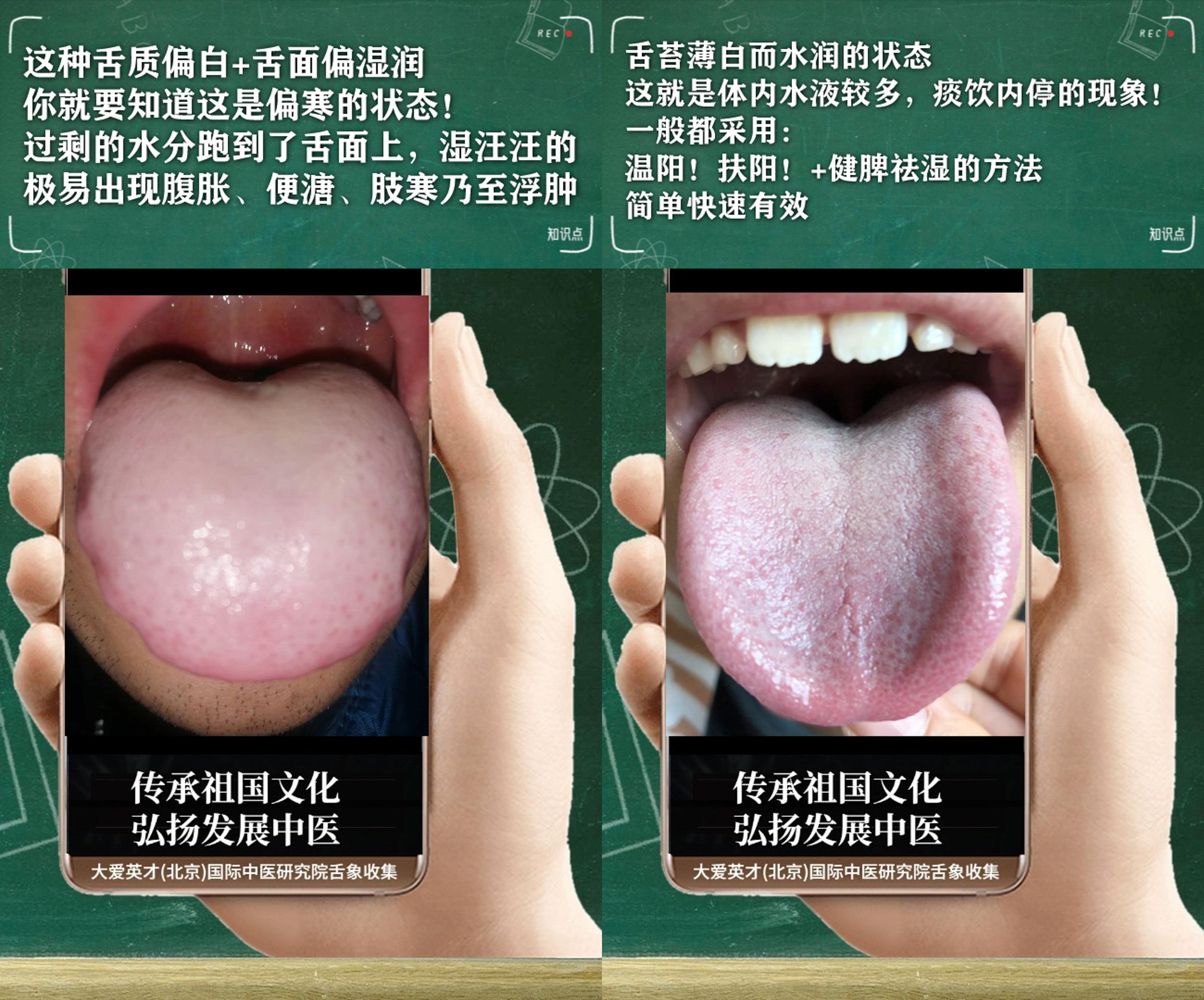 咳嗽|舌诊实例：常紧张、没有精神、经常咳嗽吐痰、一直未愈非常绝望