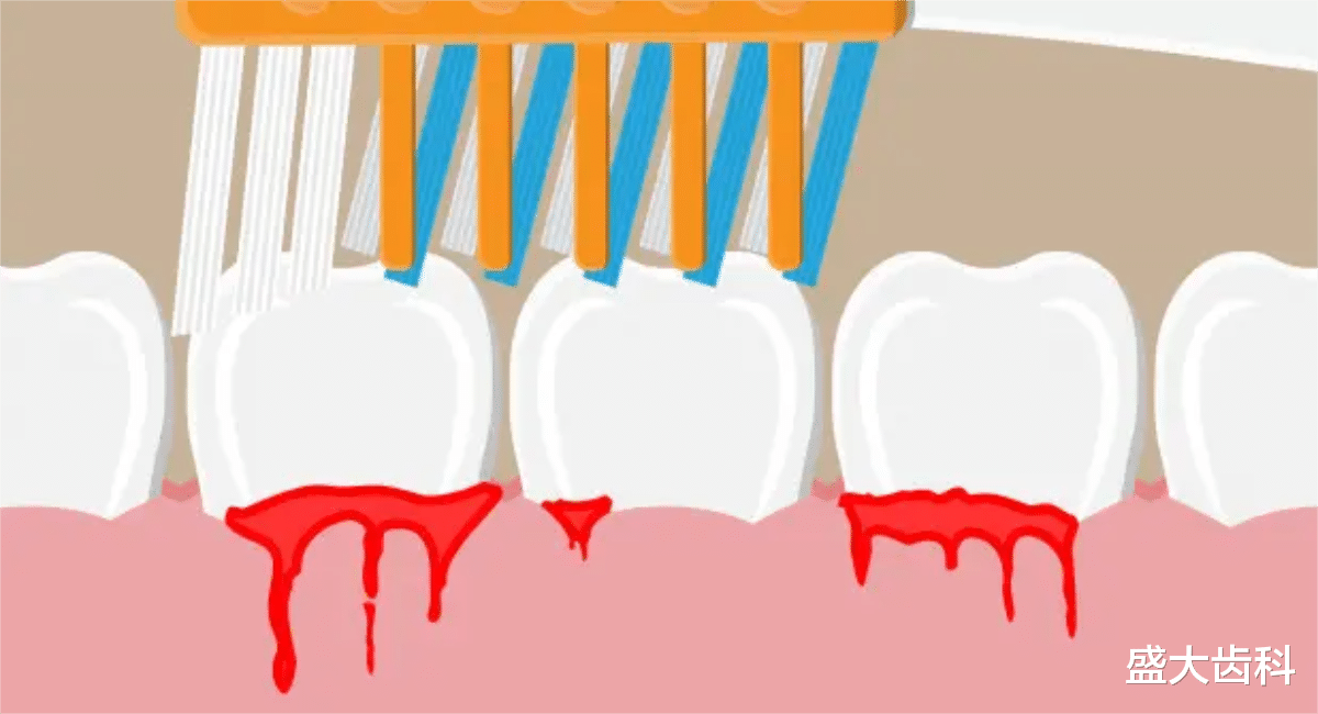 医生|牙龈出血需要看医生吗?